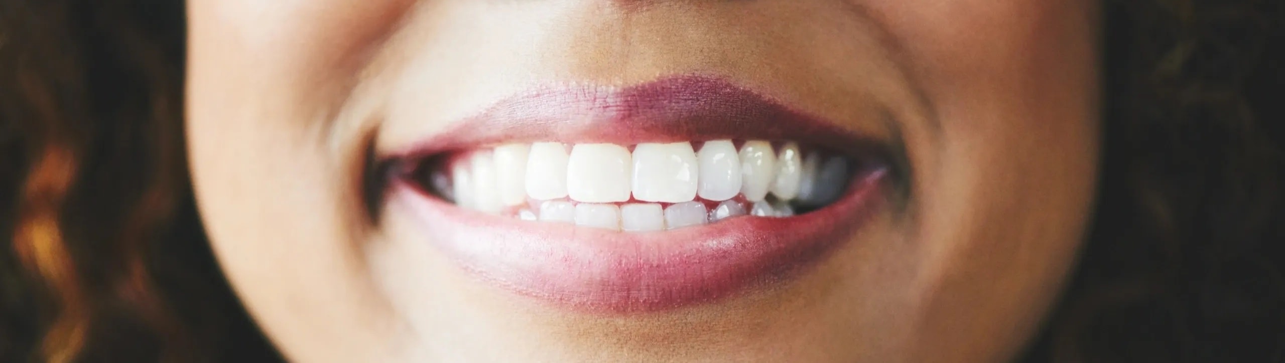 Straight smile after Invisalign