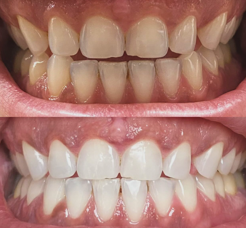 Teeth whitening before and after result 3