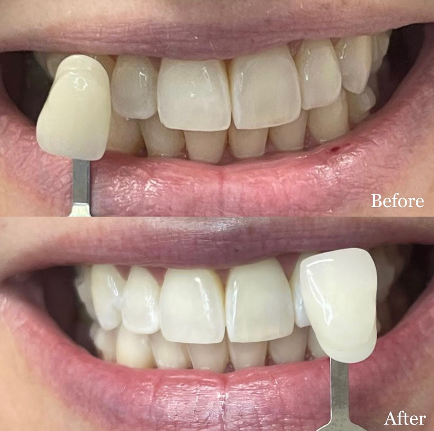 Teeth whitening before and after result 4